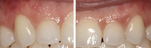 before and after pinhole surgery