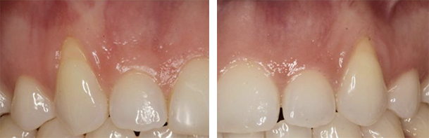 before and after pinhole surgery