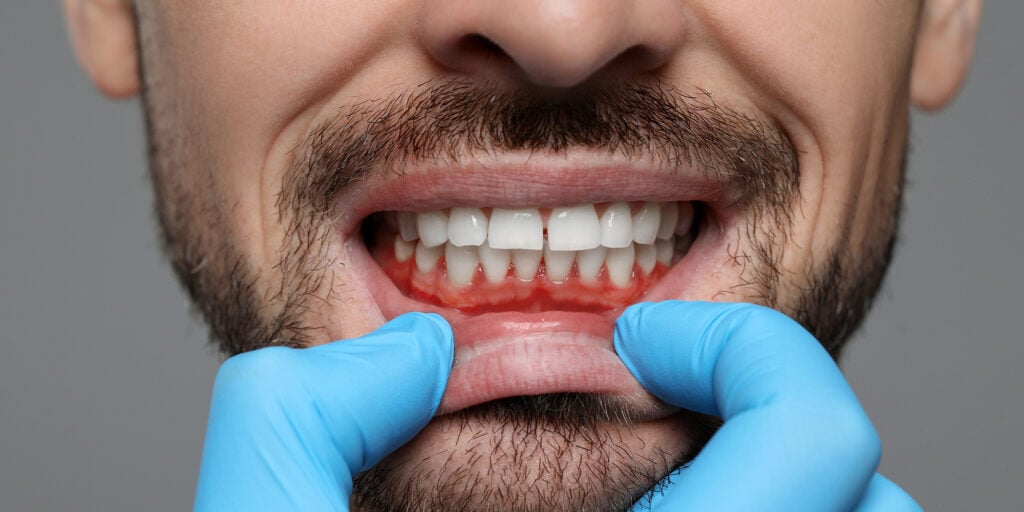 Periodontal Disease and Diabetes: A Two-Way Relationship