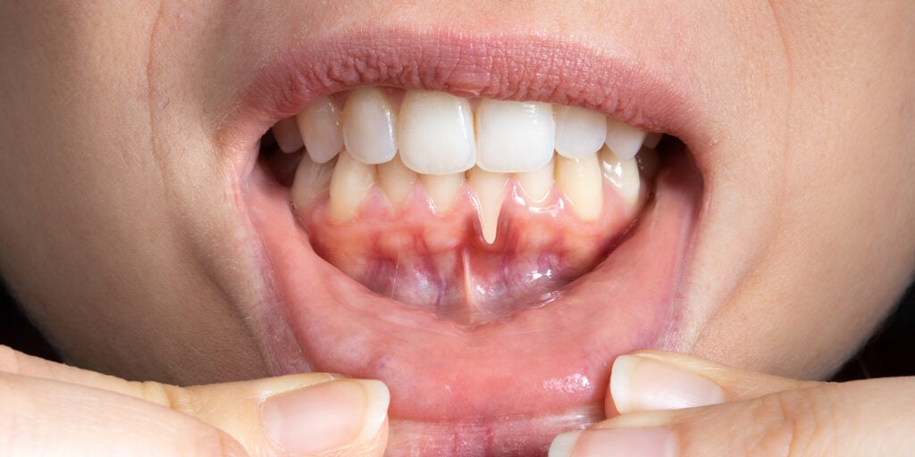 Discover a Minimally Invasive Treatment for Receding Gums