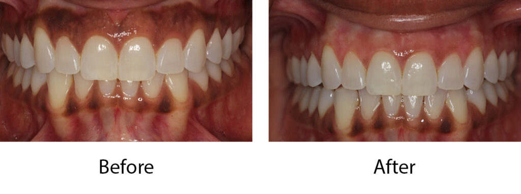 Laser Depigmentation