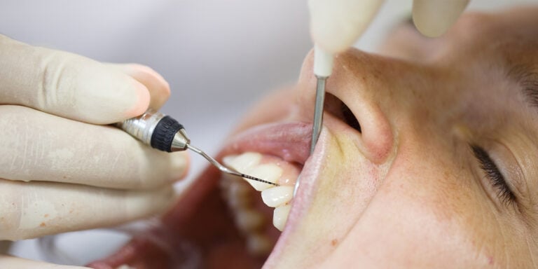 The True Cost of Pinhole Surgery vs. Traditional Gum Grafting