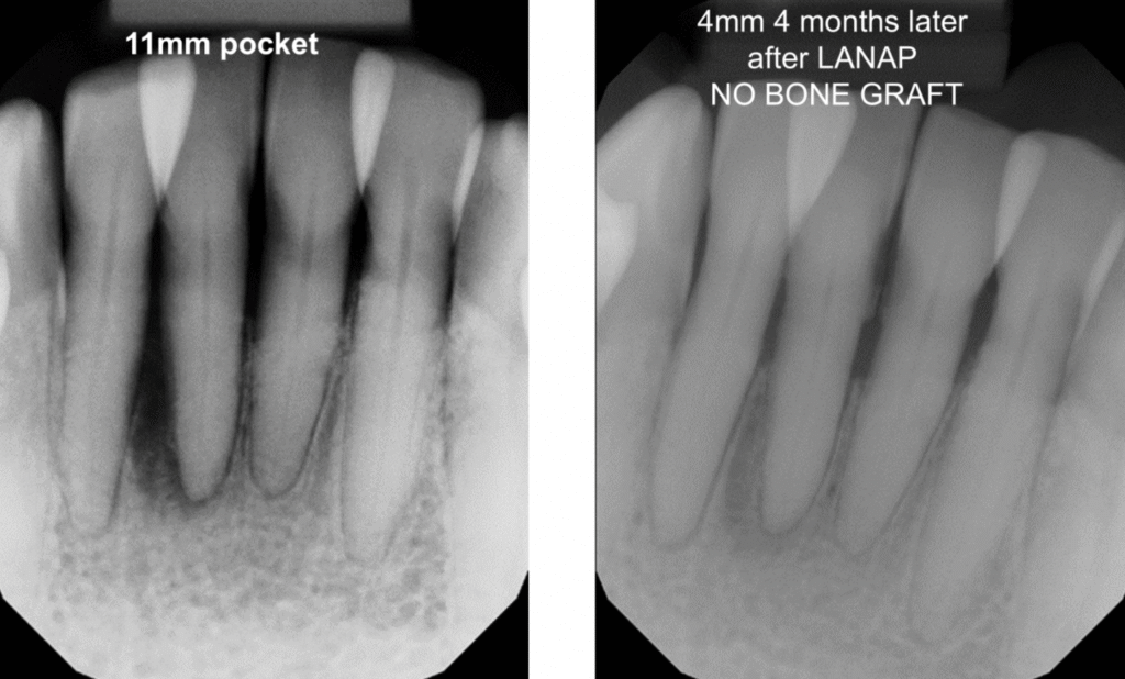 LANAP before and after pictures