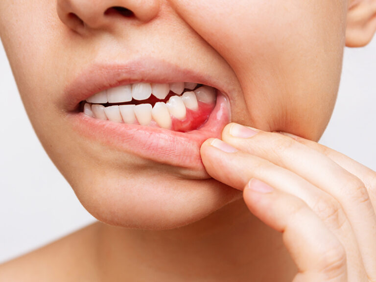 Why Are My Gums Bleeding? 6 Common Causes