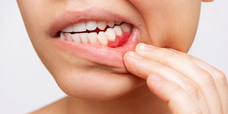Why Are My Gums Bleeding? 6 Common Causes
