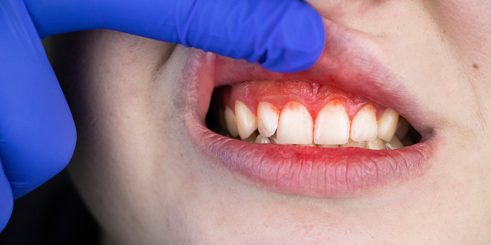 Gingivitis vs. Periodontitis: What's the Difference?