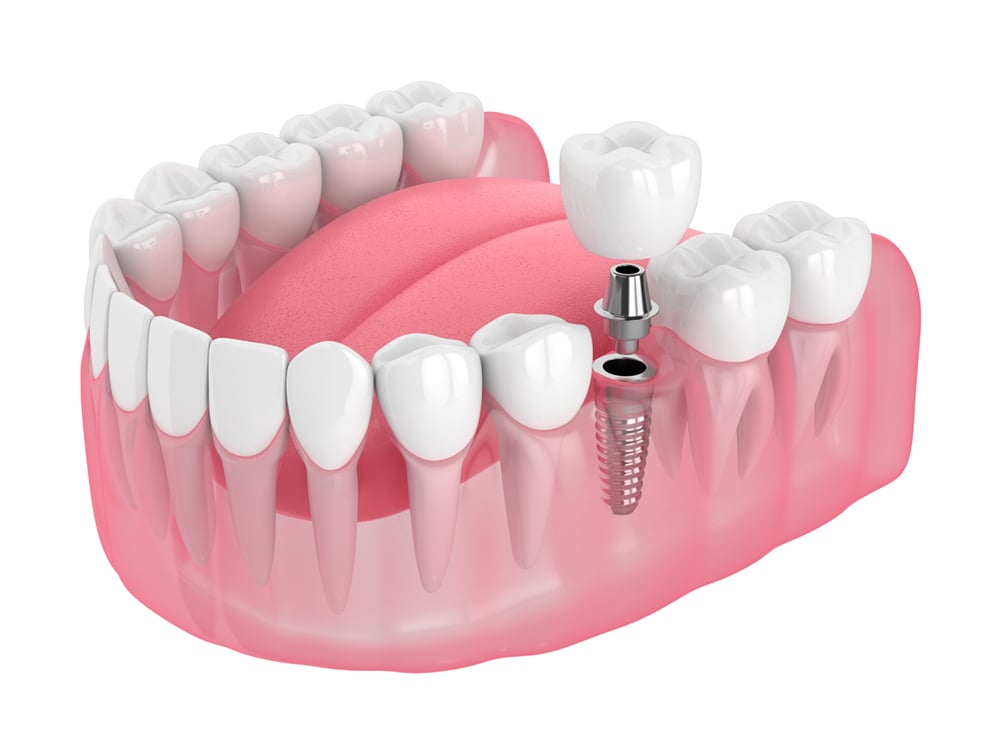 three parts of a dental implant