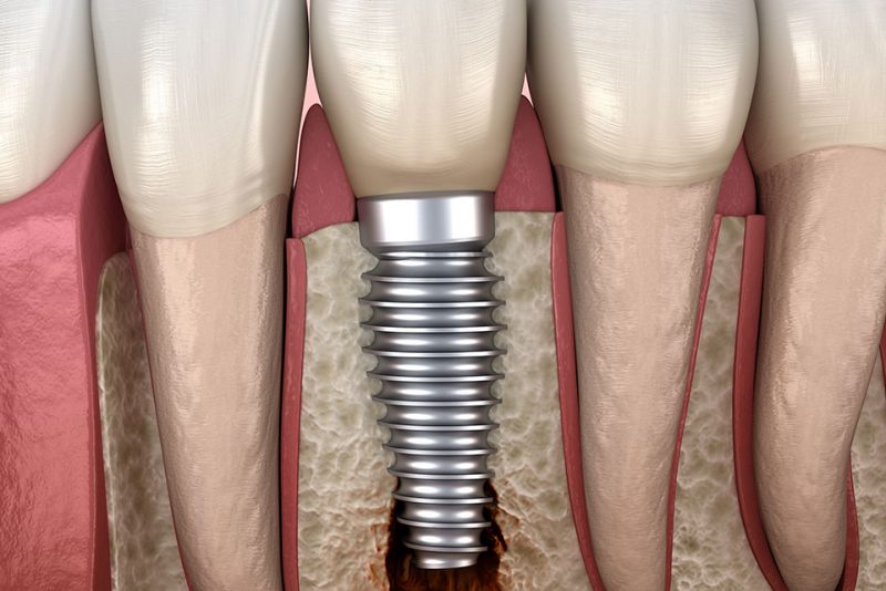 single dental implant model.